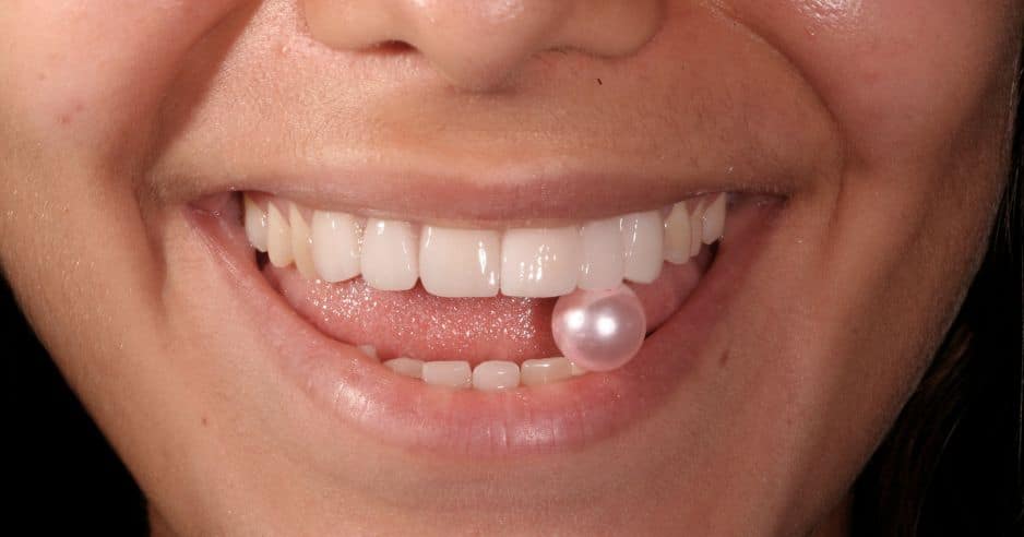 carillas-composite-barcelona-precio-2