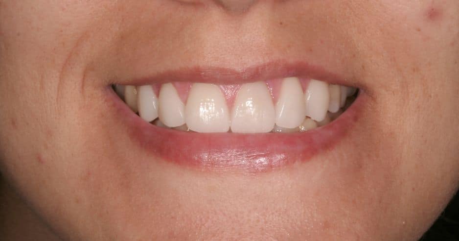 carillas-composite-barcelona-precio