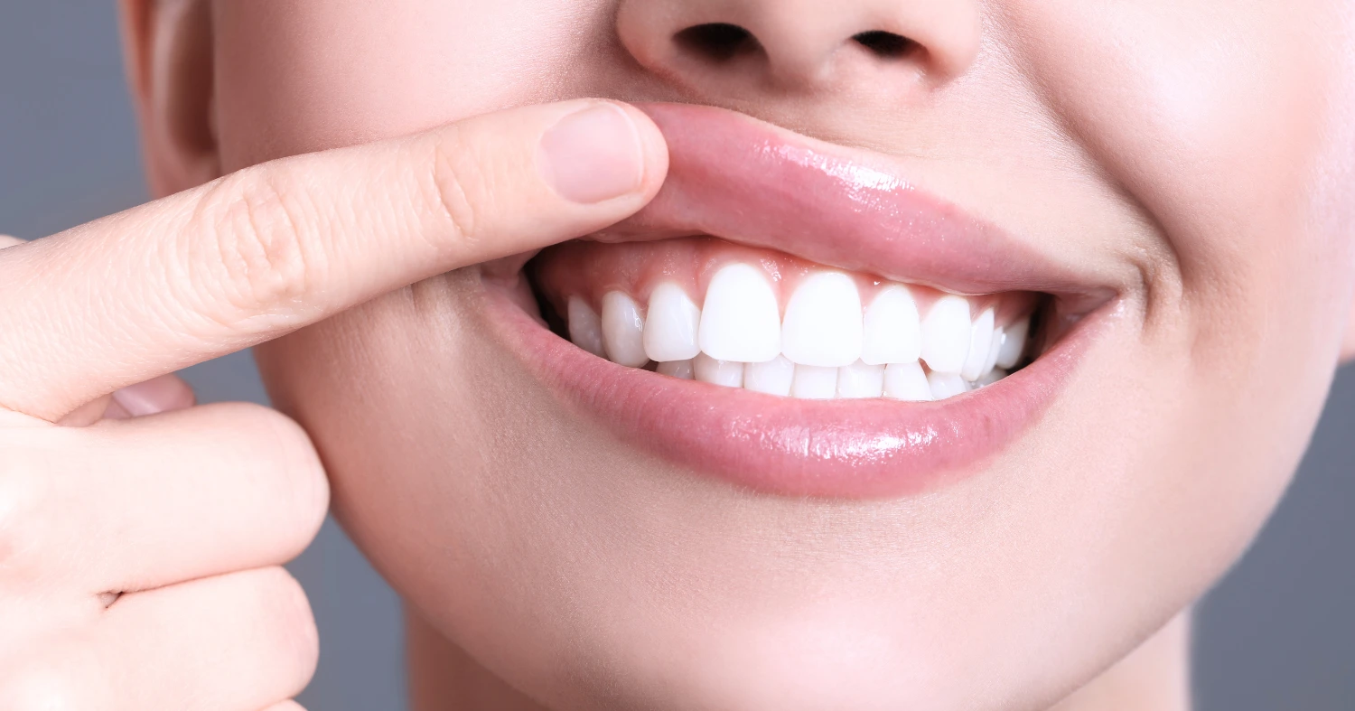 Infección de Encías