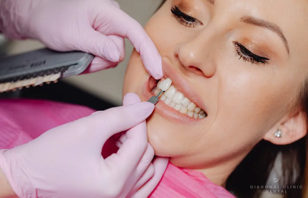 Recuperar la sonrisa después de un accidente: la experiencia real de Rachel con carillas dentales