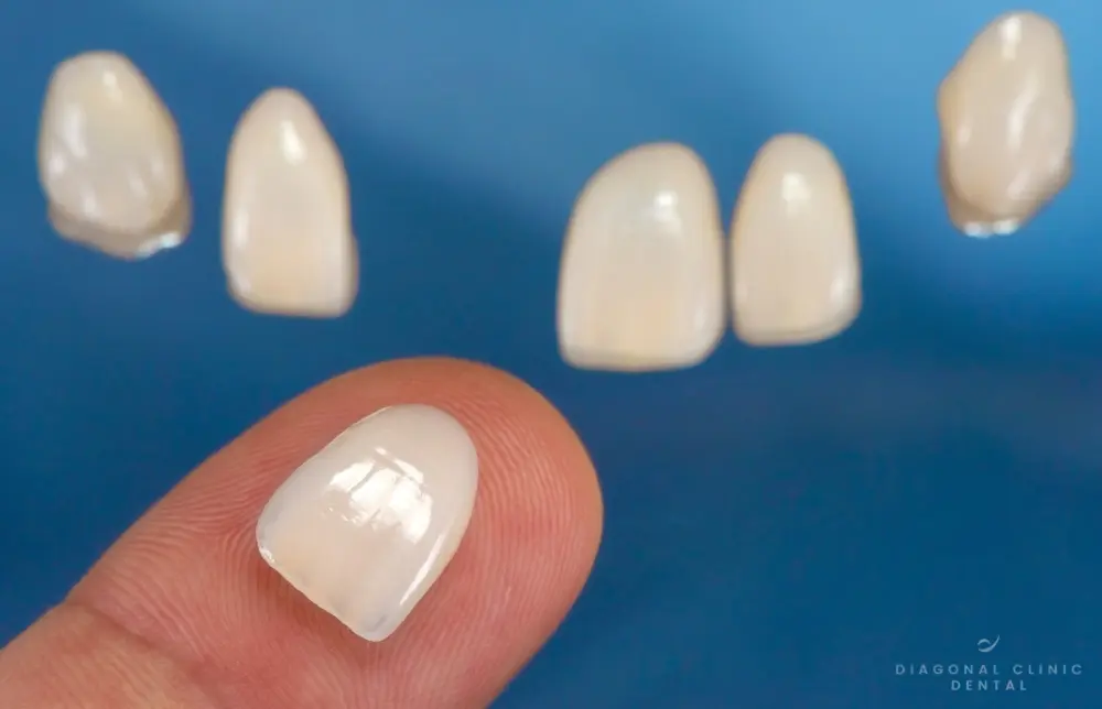 Carillas dentales en Barcelona: precio, qué incluye y número de visitas