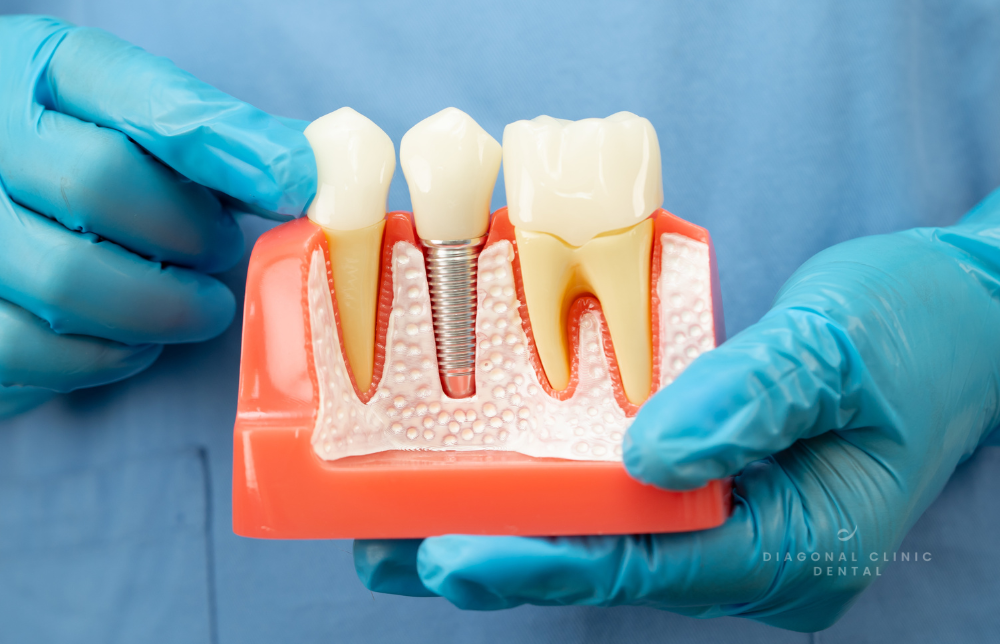 Mantenimiento implantes dentales