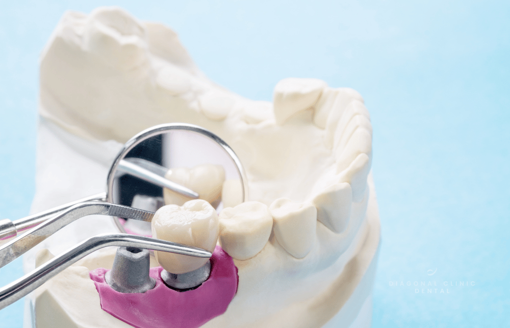 Periimplantitis: qué es, causas, síntomas y tratamiento en Barcelona