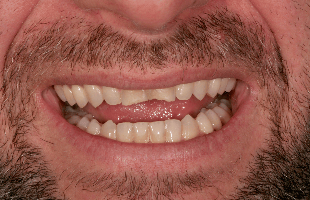 dientes rotos o desgastados