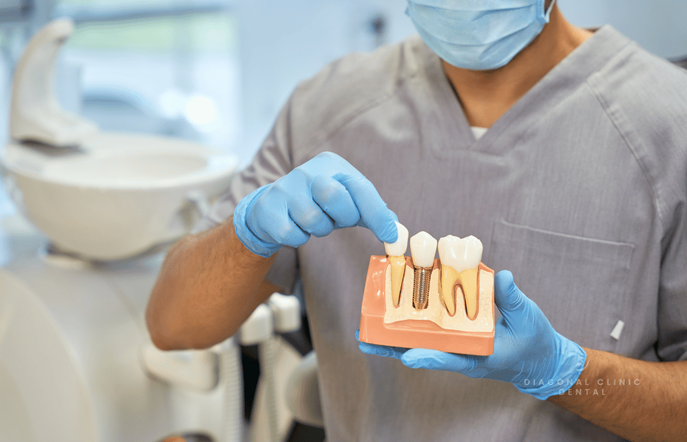 Tipos de implantes dentales: guía completa para recuperar tu sonrisa