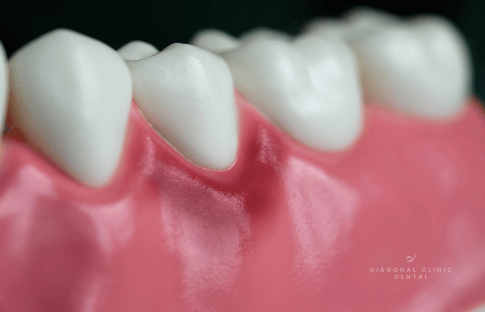 gingivitis